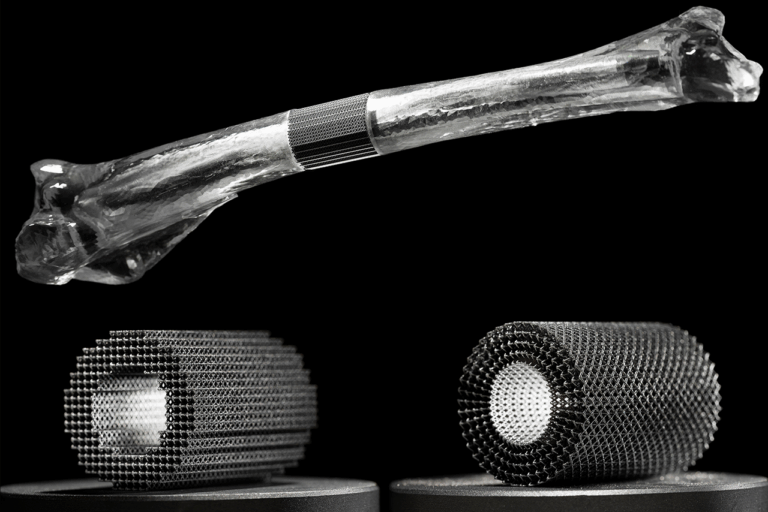 Neuer Ansatz zur Optimierung patientenindividueller bioresorbierbarer Implantat